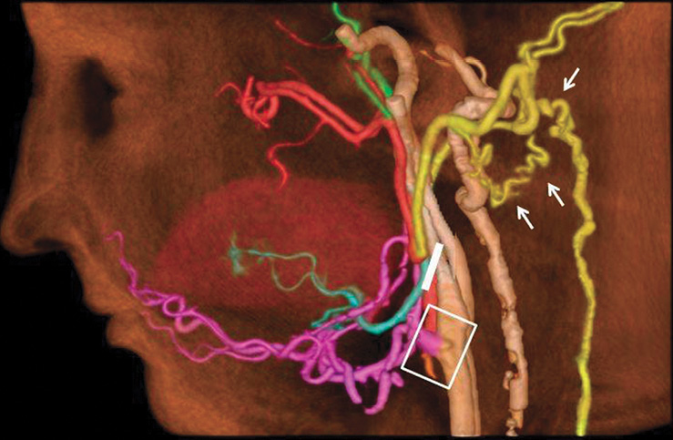 CT angiography after face transplantation